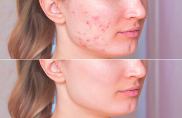Kinds and treatments of acne